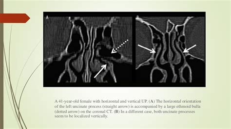 Surgical anatomy of osteomeatal complex