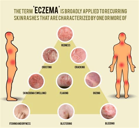 Brief Guidance on Different Types of Eczematous Dermatitis - Basic Baby ...