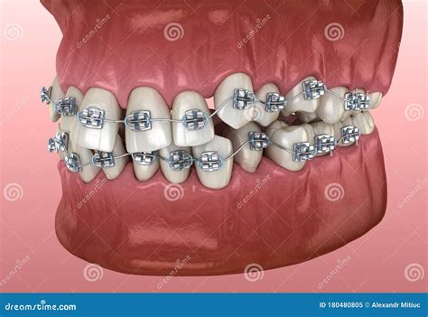 3d Render Of Jaw With Abnormal Toothing Position Isolated Over White ...