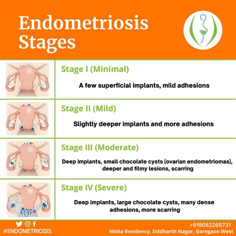 Understanding Endometriosis: Stages and Beyond