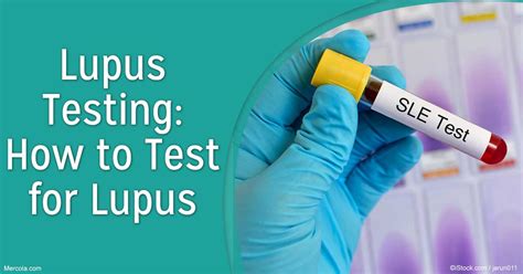 How to Test for Lupus