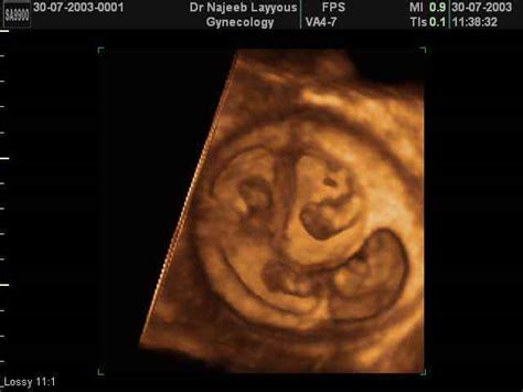 3D Ultrasound Scan photos of Multiple Pregnancy twins triplets ...