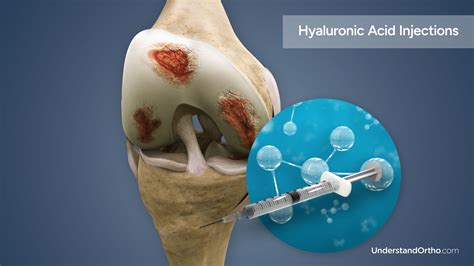 Hyaluronic Acid Injections – UnderstandOrtho™