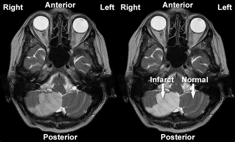 MRI Gallery - MRI Brain - Cerebellar infarct