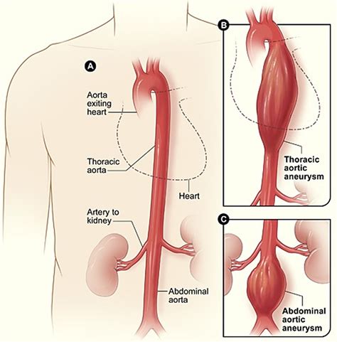 Iliac Artery - Common iliac artery, Internal & External iliac artery ...