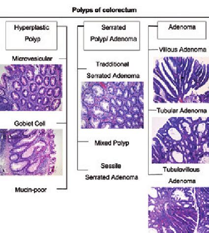 Types Of Colon Polyps Chart