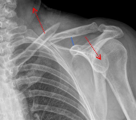 Clavicle Fracture Anatomy