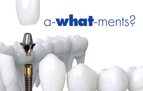 What Are Dental Implant Abutment? - Lynnfield Dental Associates Blog