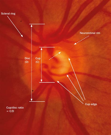 Photos Of Glaucoma Optic Nerve Cupping