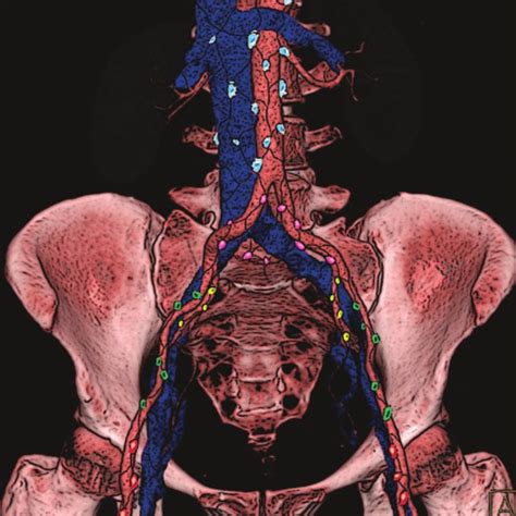 Right Inguinal Lymph Node