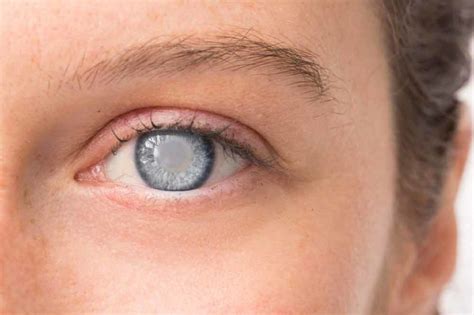 What is a Secondary Cataract? | Brooks Eye Associates