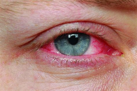 Conjunctivitis Recovery - EyeSight