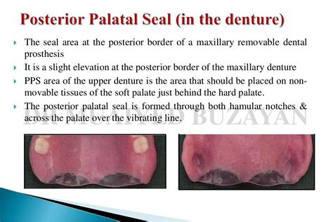 Posterior palatal seal 2nd yr