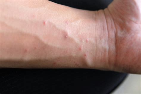 Scabies - Signs, Symptoms, OTC Treatment & Home Remedies