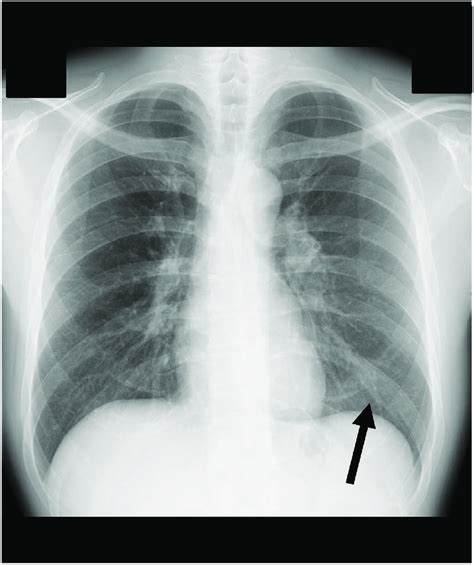 Chronic Bronchitis Chest X Ray