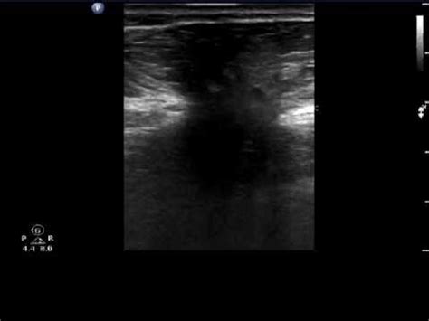 Ultrasound and Color Doppler videos: Ultrasound imaging of large ...