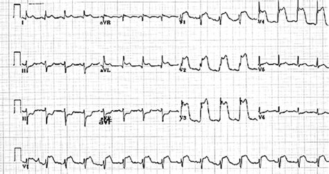 e ECG showing anterior wall MI [ST elevation in leads V1-4] with ...