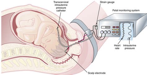 Fetal Surveillance during Labor | Obgyn Key