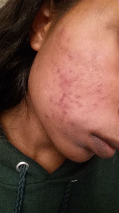 Acne Scars and Hyperpigmentation - Beauty Insider Community