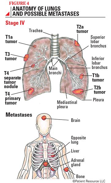 Lung Cancer-old - SITC connectED