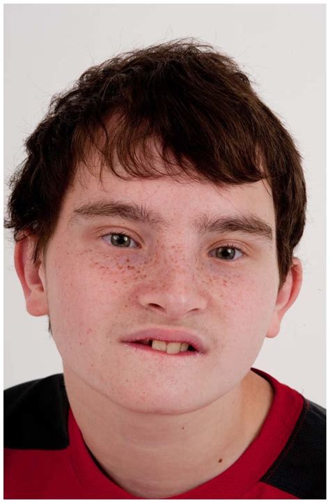 Frontal view of Patient 3 at age 15 years. He was originally diagnosed ...