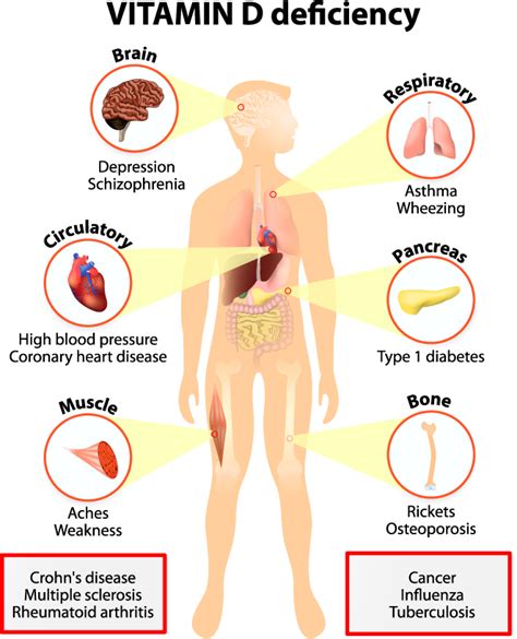 Vitamin D Deficiency, Signs, Symptoms, Causes, Treatment and Management ...