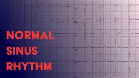 Sinus Tachycardia Normal Sinus Rhythm Ekg - Sinus Tachycardia Litfl Ecg ...