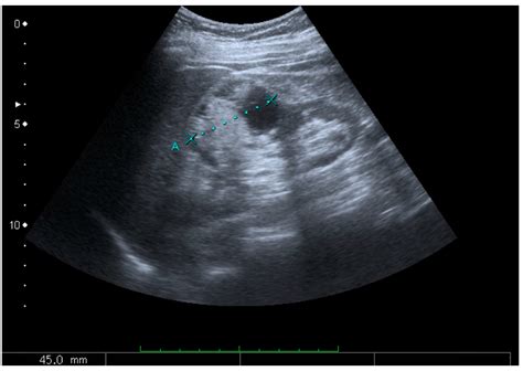 Kidney Ultrasound Test