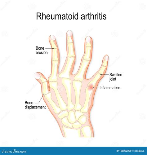 X-ray Hand - Arthritis Stock Illustration | CartoonDealer.com #12716473