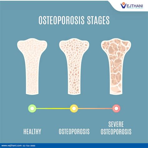 Osteopenia and osteoporosis