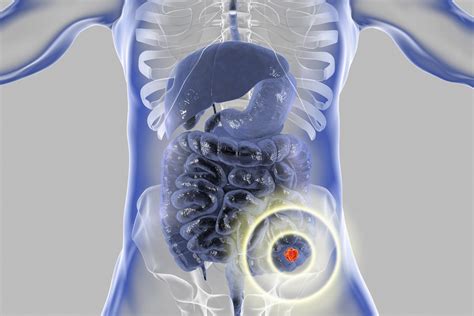 Treatment for Liver Metastasis From Colorectal Cancer