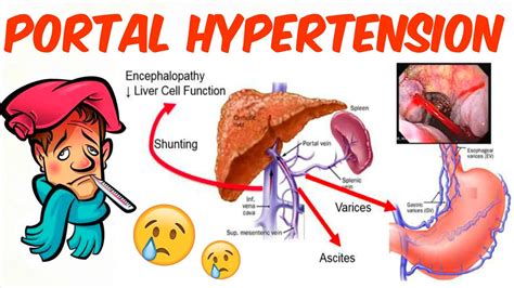 Ascites In Portal Hypertension