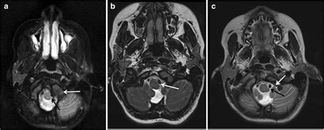 a Axial T2-weighted MRI at the level of the foramen magnum ...