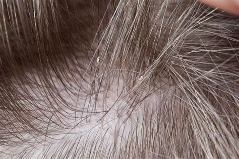 Close up of head lice egg. | About Nits-Lice eggs | Lice eggs, Eggs