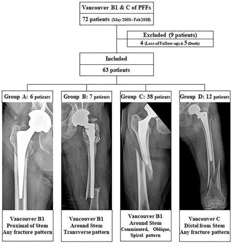 Femur Fracture Anatomy