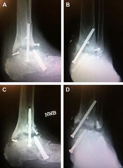 Arthrodesis | Musculoskeletal Key