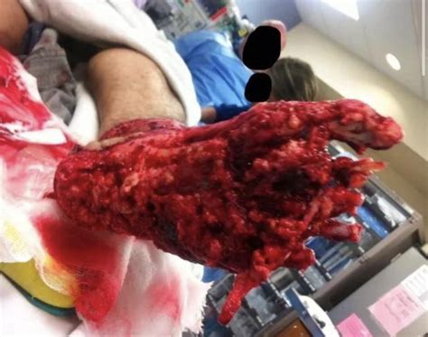 degloving injury from motorcycle accident : r/MedicalGore