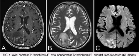 Figure 1 from Balamuthia mandrillaris brain infection: a rare cause of ...