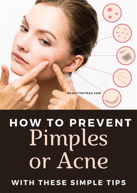 How to Prevent Pimples or Acne: Tips and Home Remedies - BeautySutras