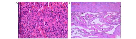 Giant Cell Tumor Histology