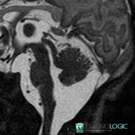 Radiology case : Cerebellar hypoplasia (MRI) - Diagnologic