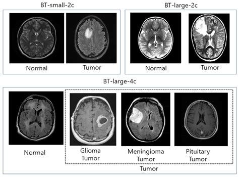 Brain Mri Tumor