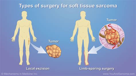 Diagnosing and Treating Soft Tissue Sarcoma