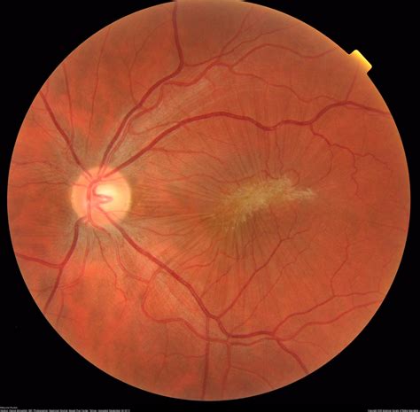 Macular Pucker/Epiretinal Membrane | Annan Retina Eye Center