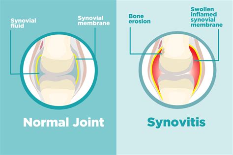 What Is Synovitis, and How Does It Affect Arthritis? – CreakyJoints