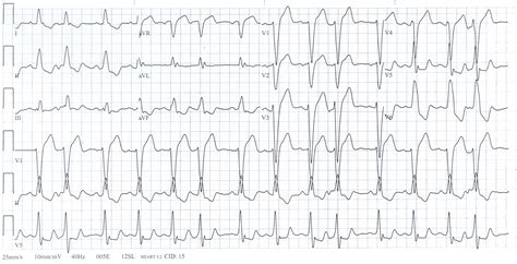 left bundle branch block | Dr.S.Venkatesan MD