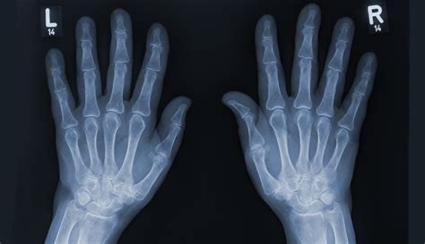 Hand X-Ray: Anatomy, Procedure & What To Expect