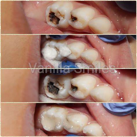 Silver diamine fluoride, Superfloss and Glass ionomer for caries control