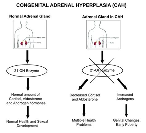 21 hydroxylase deficiency causes, symptoms, diagnosis, treatment ...
