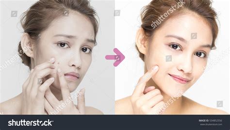 Acne Care Young Woman Before After Stock Photo 534852556 | Shutterstock